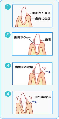 歯周病の進行度合い